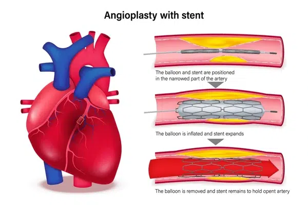 Angioplasty & Stenting in India via VNR Medical Service