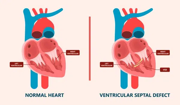 Pediatric Heart Surgery in India via VNR Medical Service